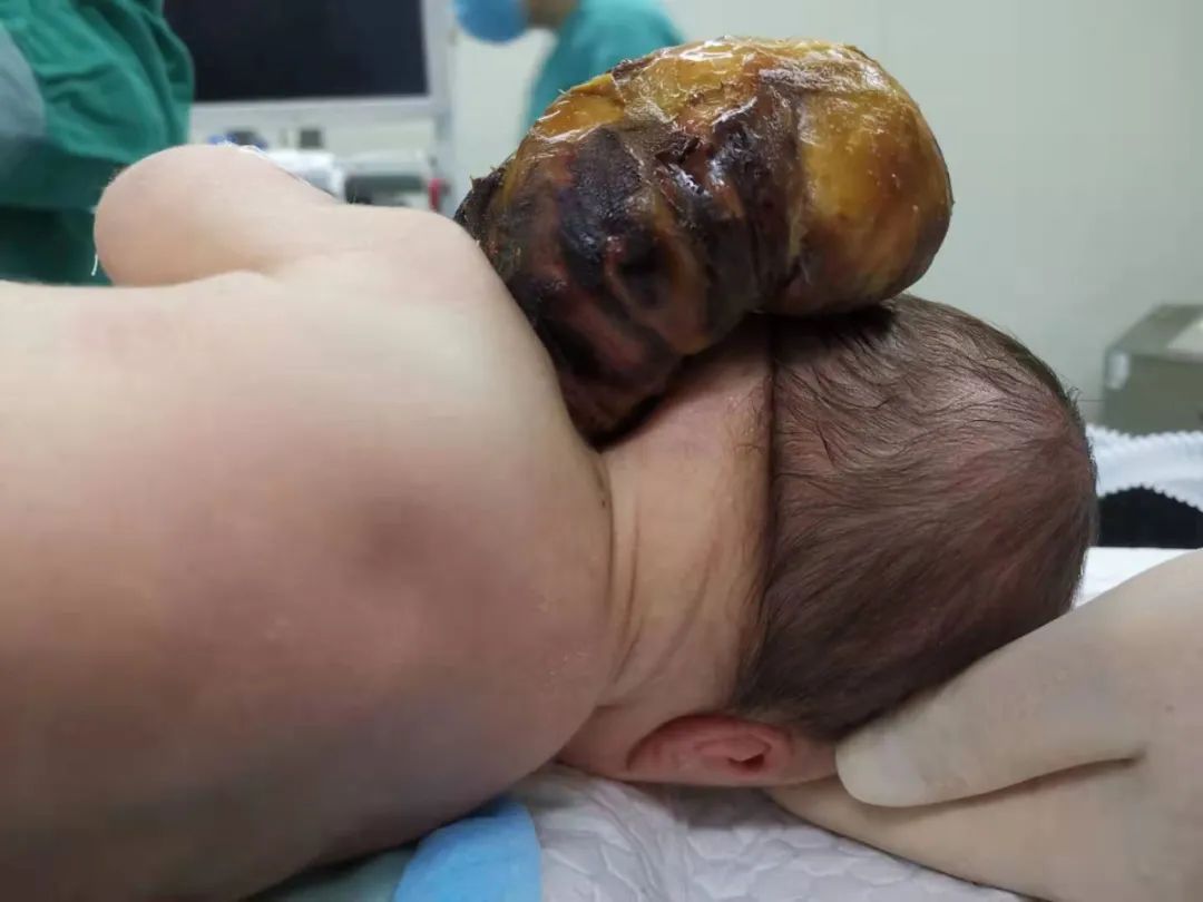 江西省儿童医院成功为出生六天男婴切除颈部如「头」般大的肿瘤