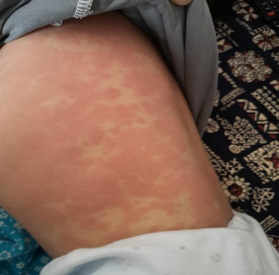 发热、皮疹……每一个「红孩儿」要警惕这种病