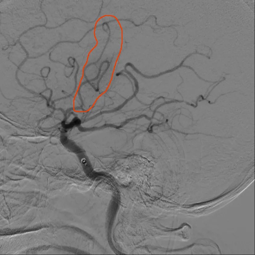重度中风，致残率高达 75%，7 旬老人却成功逃过偏瘫、失语后遗症