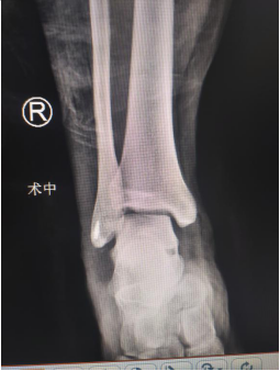 初中男生右踝骨折，医生关节镜下「微切口」复位骨折修复韧带