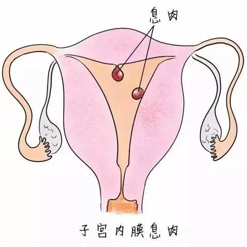 仅 4 颗窦卵泡+重度巧囊+宫腔环境恶劣的她，迎来了梦寐以求的好孕