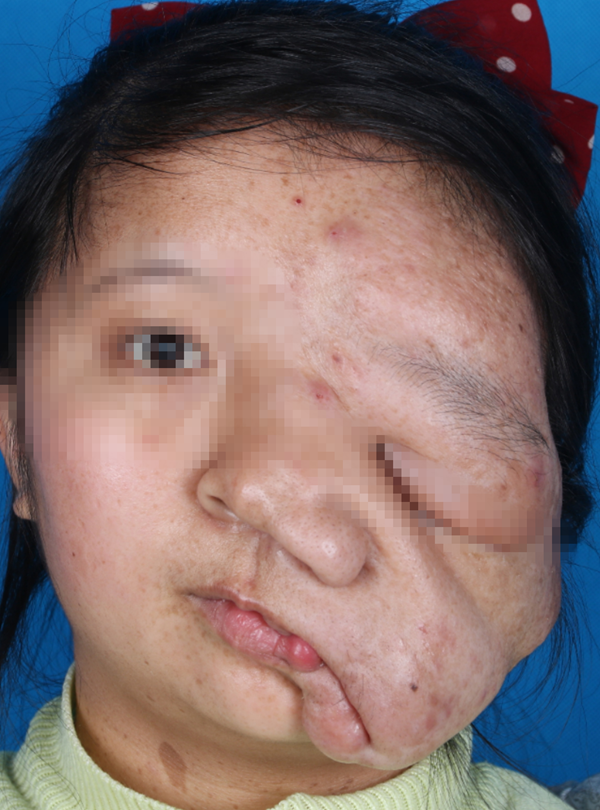 肿瘤将少女脸压变形，西安交大一附院多学科联手为她换新颜