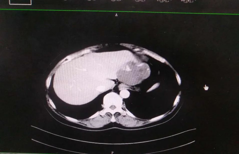 微创「拆弹」，肝胆外科成功实施腹腔镜下肝血管瘤微波消融术