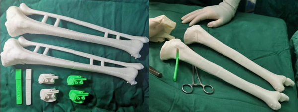 西安交通大学第二附属医院骨关节外科利用“天眼”机器人实施保膝截骨手术