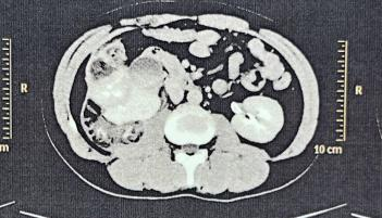中南大学湘雅二医院成功实施全省首例机器人辅助下输尿管肾下盏吻合术