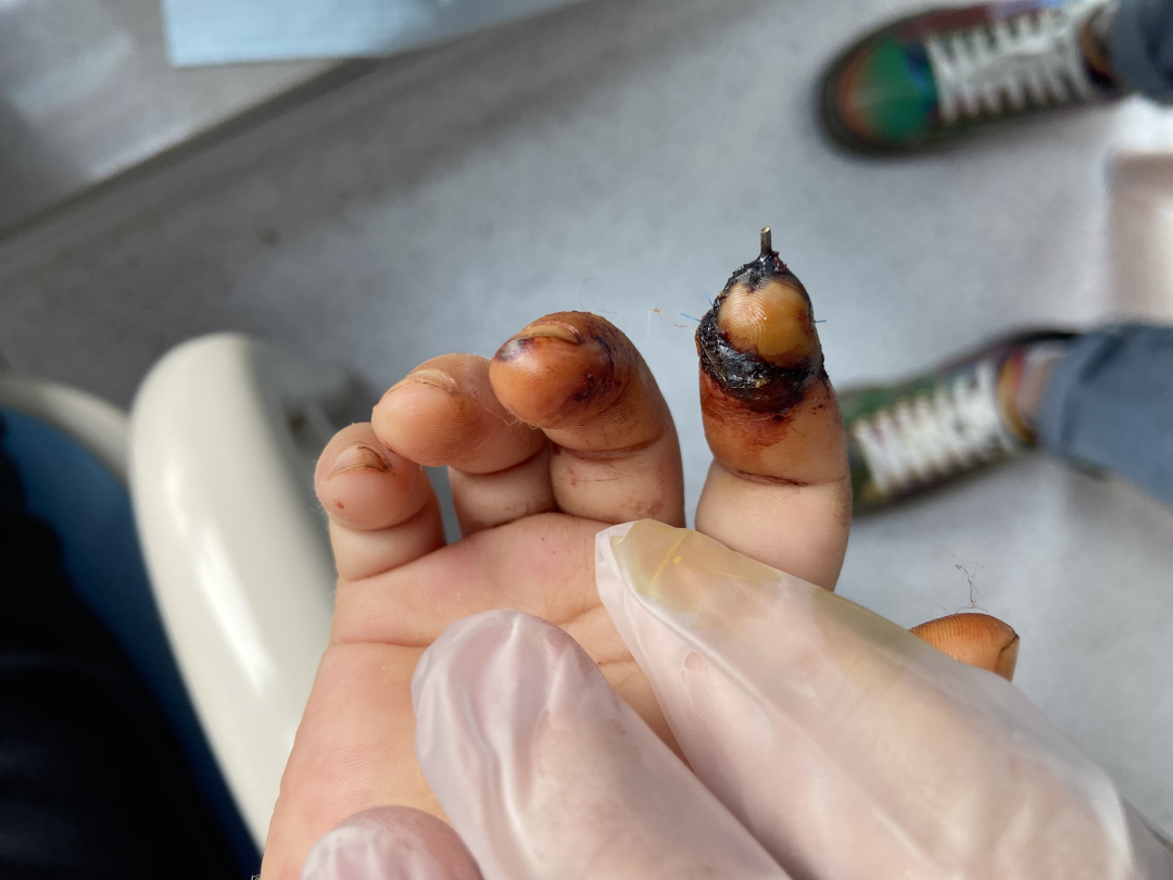 重庆北部宽仁医院骨科再创世界级水平：2 岁幼儿末节手指断指再植成功