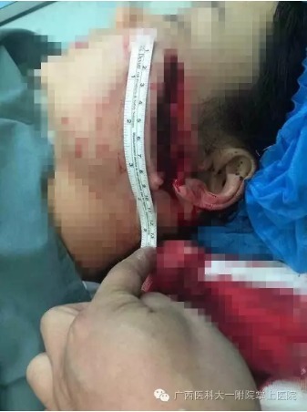 广西：医务人员被「医托」公开报复 疯狂砍伤！