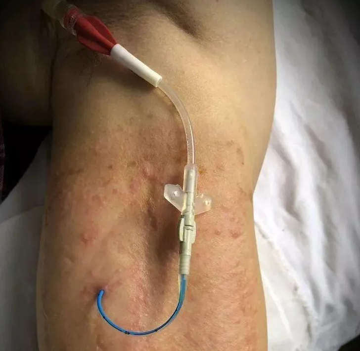 管友之家——西安市中医医院外科 PICC 维护门诊