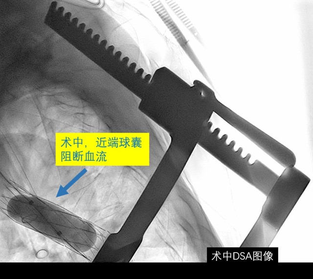 上海德达医院成功完成首例胸腹主动脉联合置换术