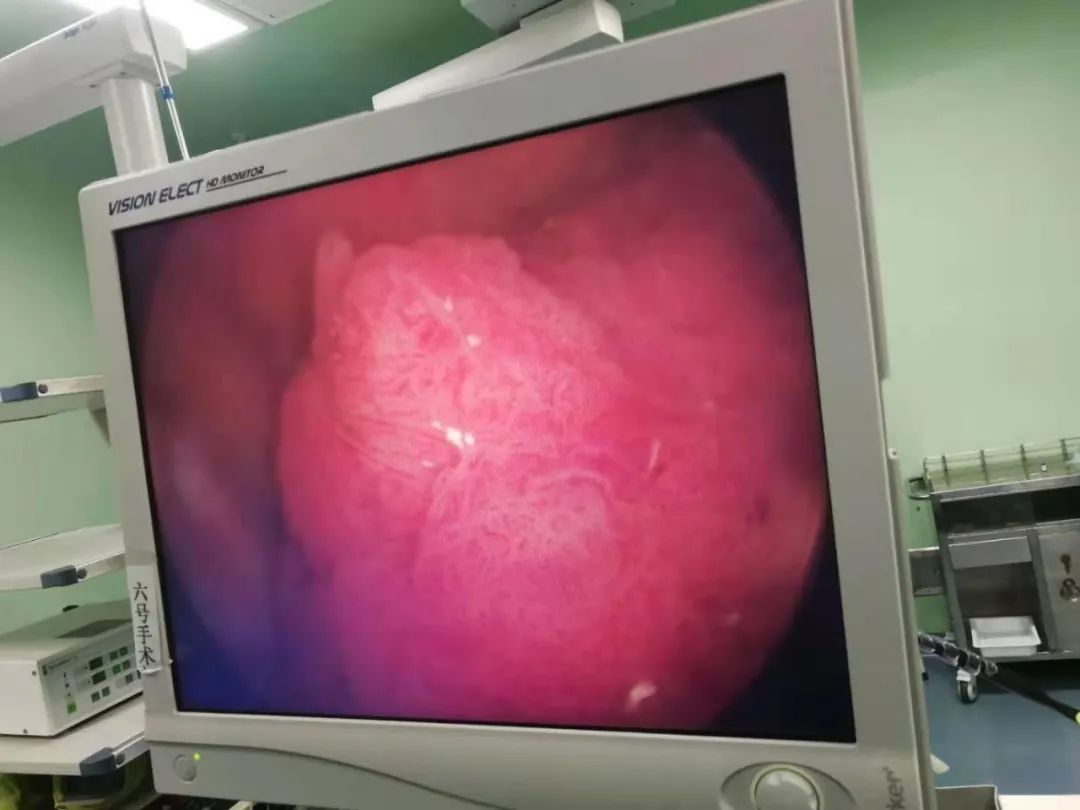 跨越微创手术「雷区」，烟台海港医院泌尿外科实施侧壁膀胱肿瘤整块剜除术