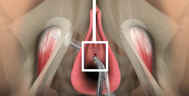 乐山市中医医院泌尿外科率先开展单切口尿失禁手术（SIS 手术）