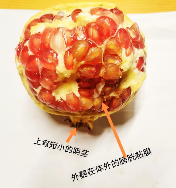 5 岁男童膀胱外翻寻医无门，江西省儿童医院为其托起最后的希望