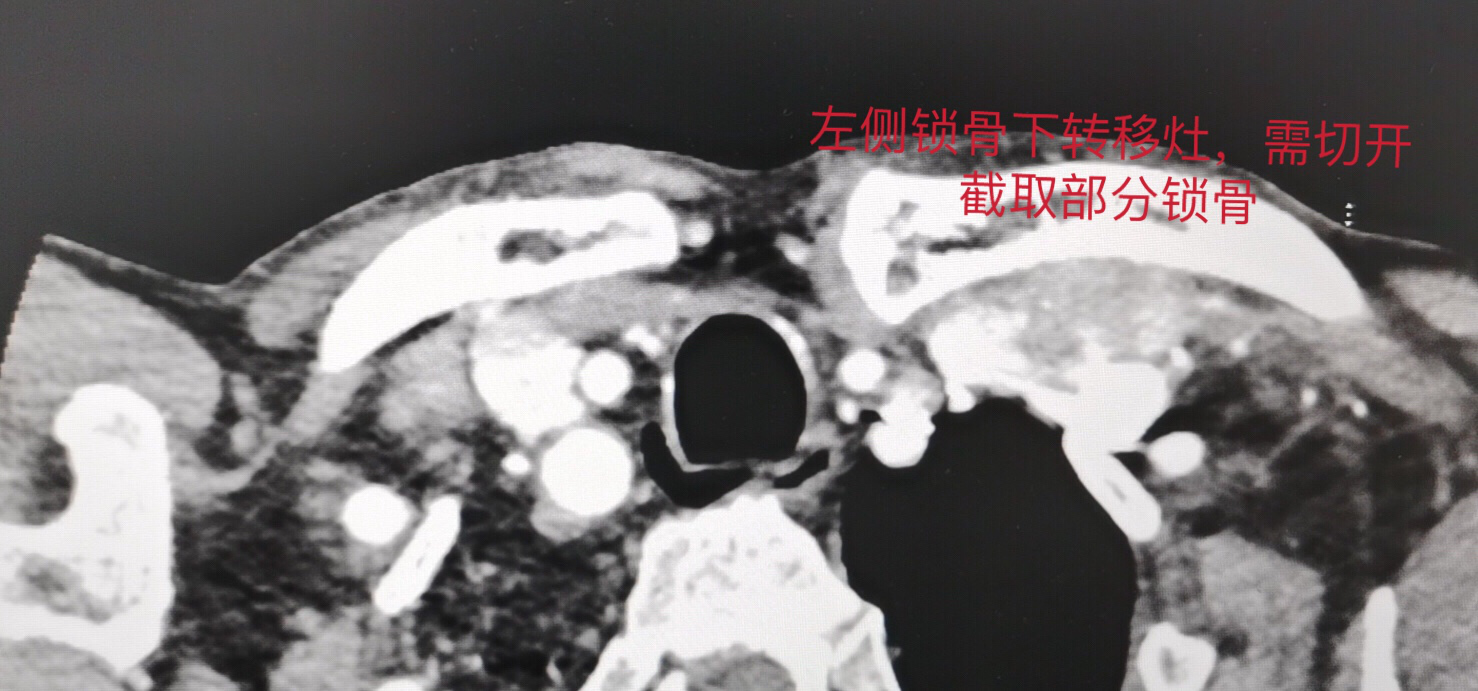 南昌大学第二附属医院多学科协作成功完成一例复杂甲状腺癌全切除术