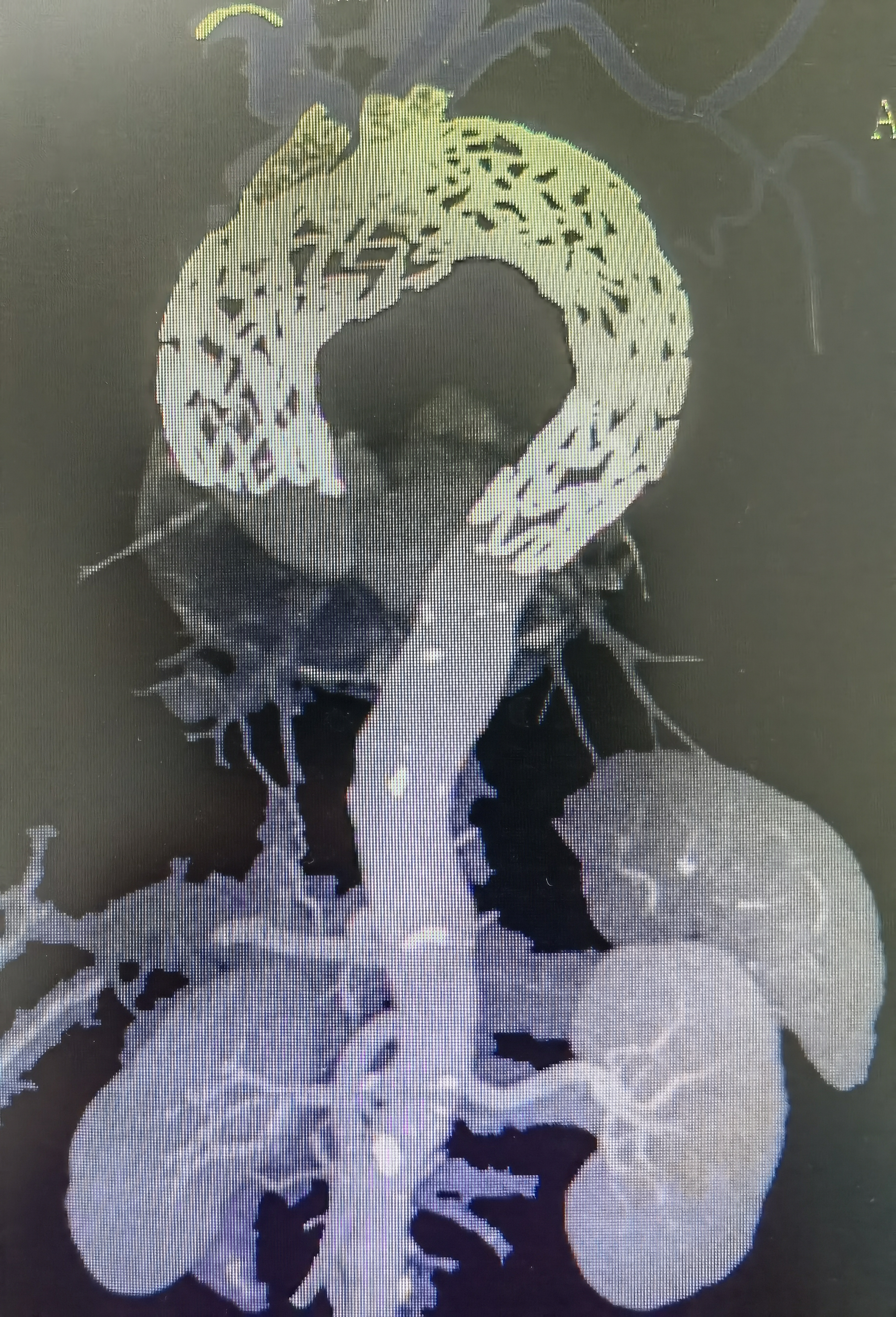 武汉大学人民医院应用体外 3D 模型重建人体最大血管降服主动脉瘤