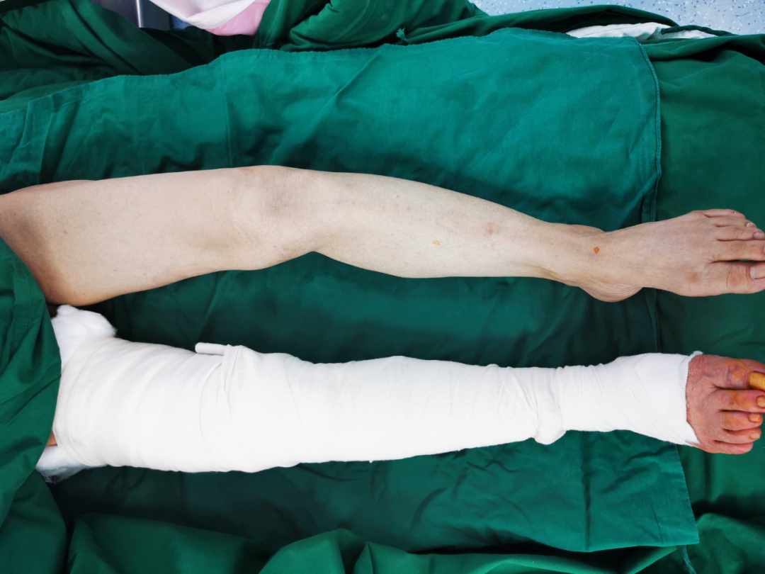 宁城县中心医院骨一科成功为一位高龄双膝重度骨性关节炎患者实施双膝关节表面置换术