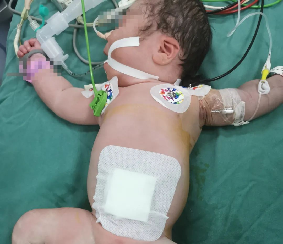 刚出生婴儿肠管裸露在外 江西省儿童医院紧急手术