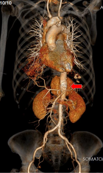 腔内「八爪鱼」技术，满足复杂血管手术需要
