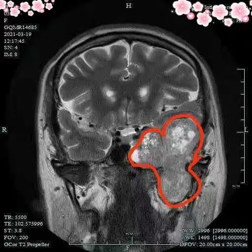 贵黔国际总医院：巨大肿瘤横跨中后颅底，中年妇女危在旦夕