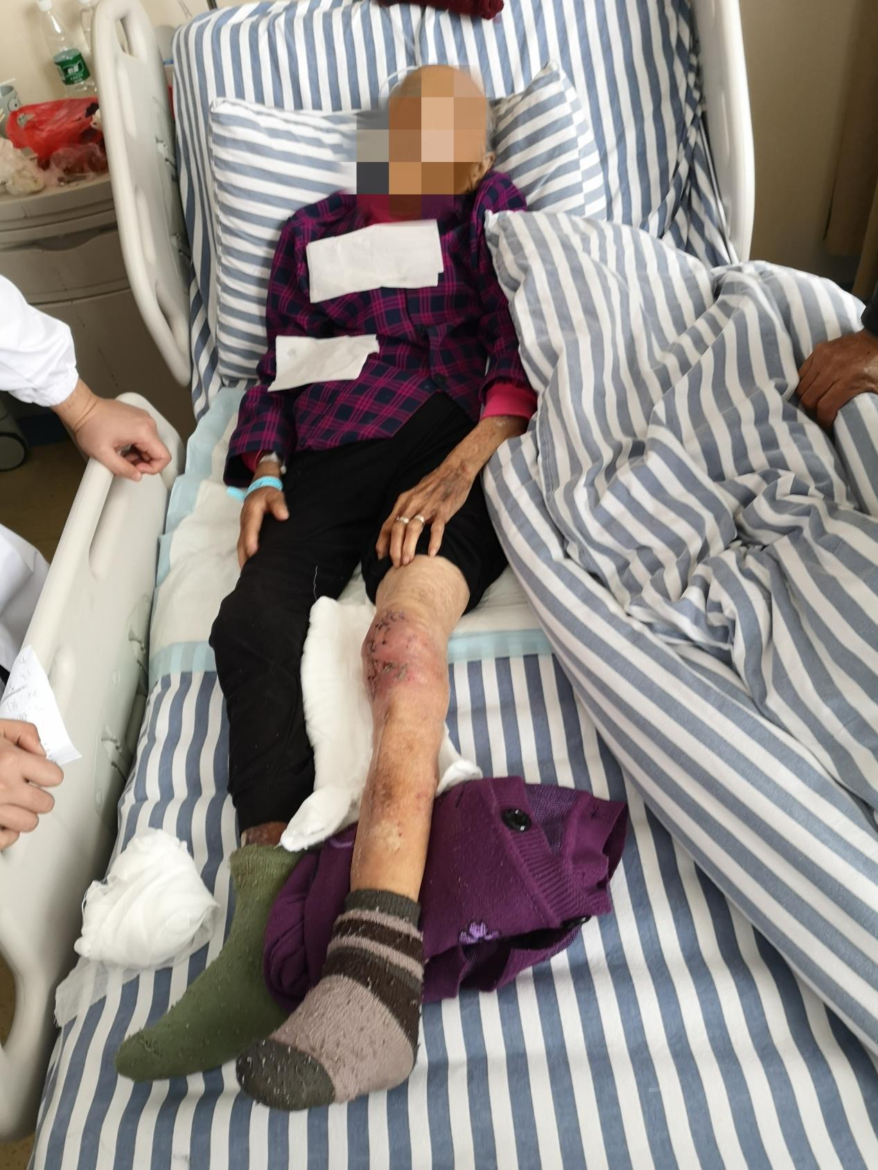 南昌大学第二附属医院整形美容科杨立文教授团队成功为 105 岁患者开展带蒂皮瓣移植术