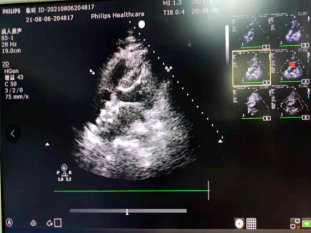 深圳市首例!龙岗区人民医院为房颤、房缺患者消除「隐形炸弹」!