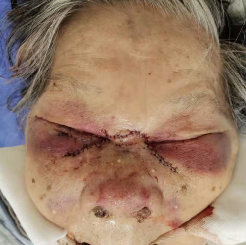 同济大学附属同济医院整形美容外科成功为一94岁高龄患者一期完成创伤救治及美容修复