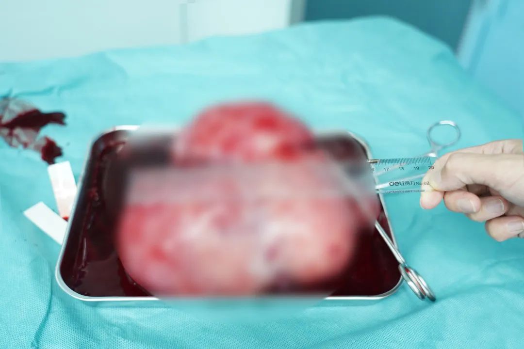 前海人寿广西医院妇产科为患者成功切除巨大子宫肌瘤