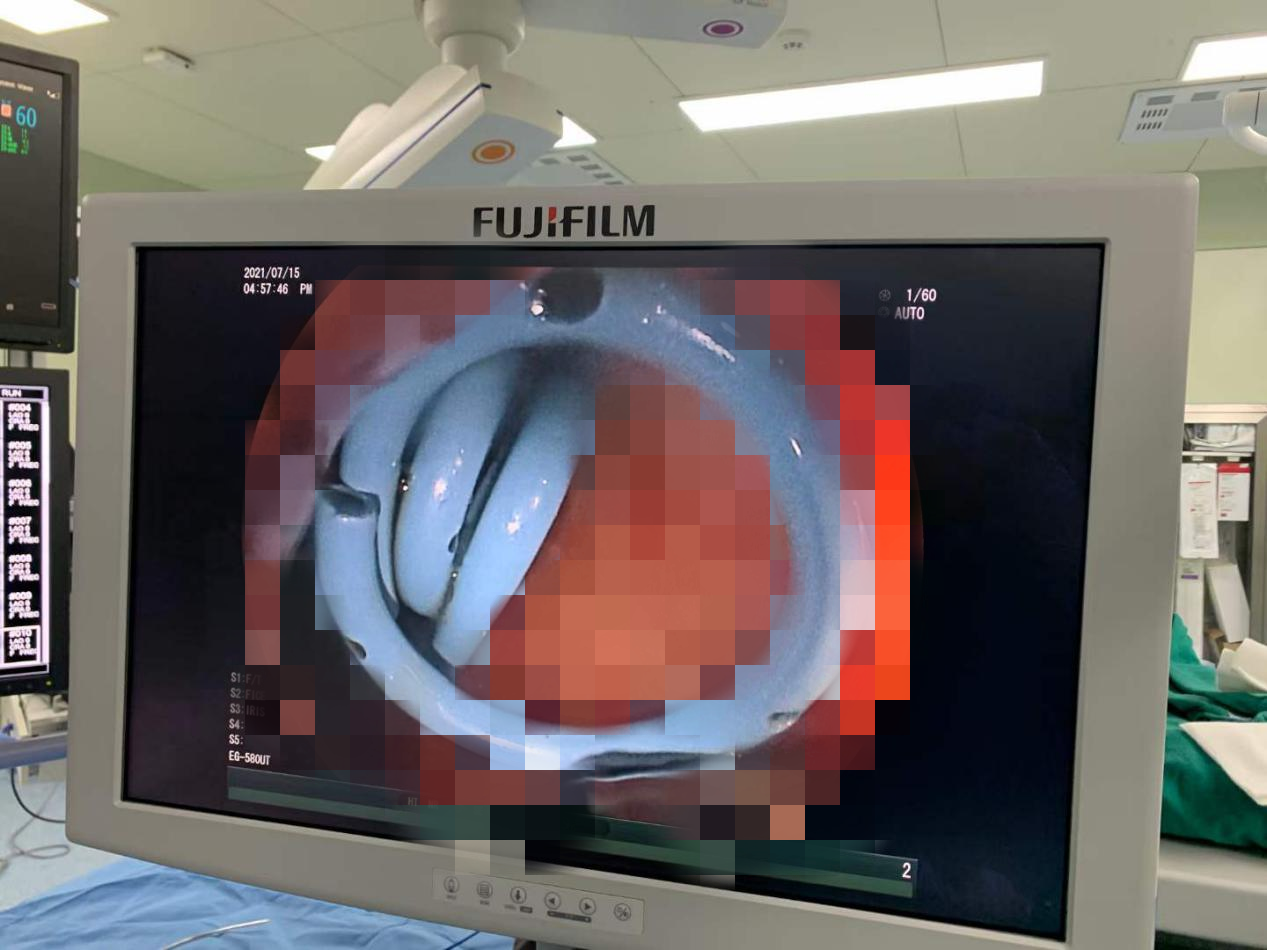 南昌大学二附院消化内科成功完成一例纵轴超声内镜引导下经胃双猪尾支架置入术