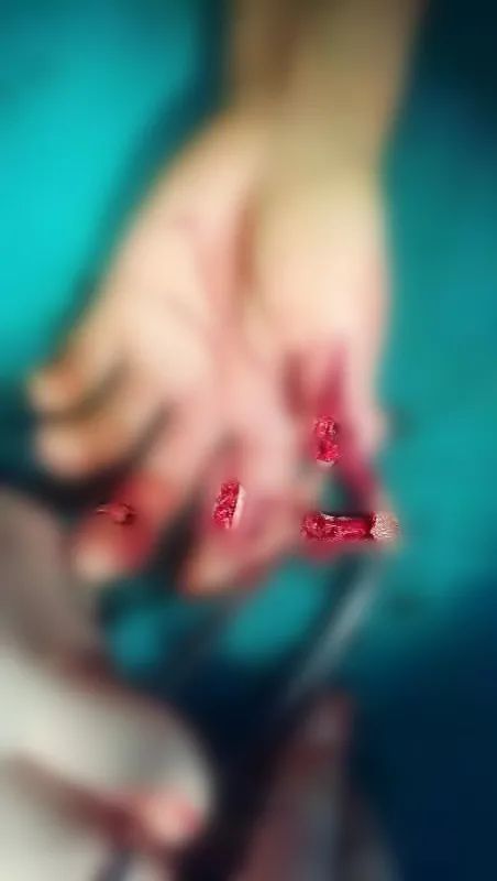 「移花接木」拇指再造，上海海华医院成功完成一例复杂拇指再造术