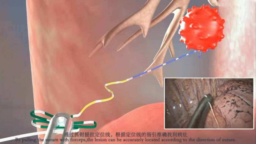 重庆北部宽仁医院多学科联合为 80 岁老人一次性切除 4 个肿瘤
