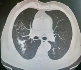 烟台海港医院呼吸内科治愈一名肺部严重感染者，找到疾病元凶！