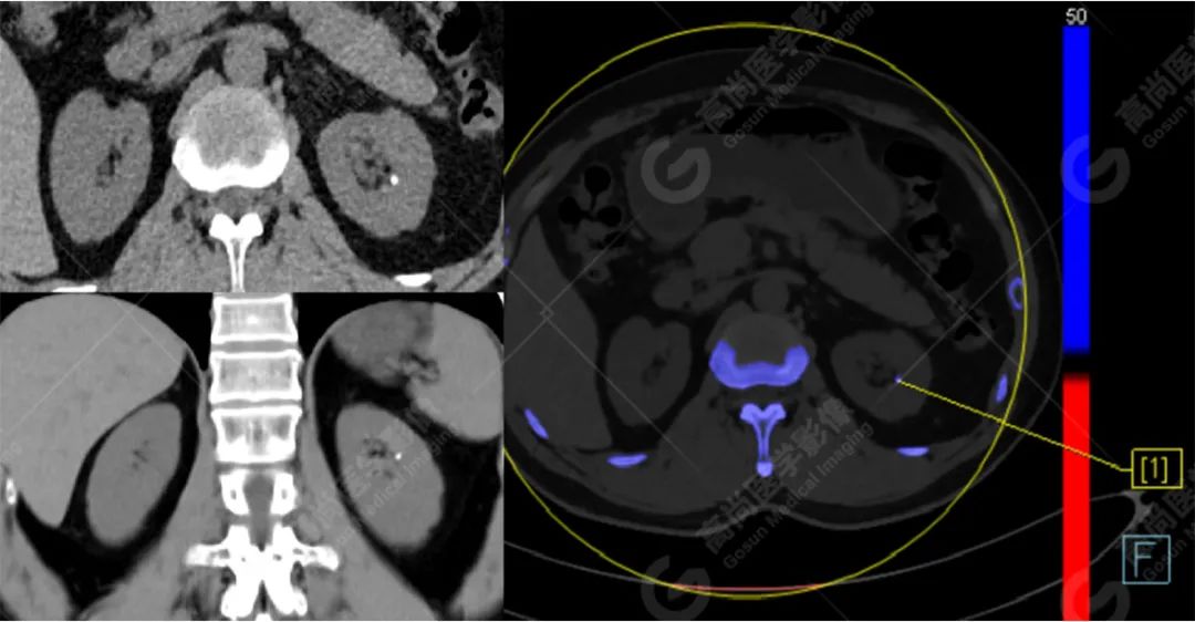 高尚病例:双能量 CT 成像分析泌尿系结石成分