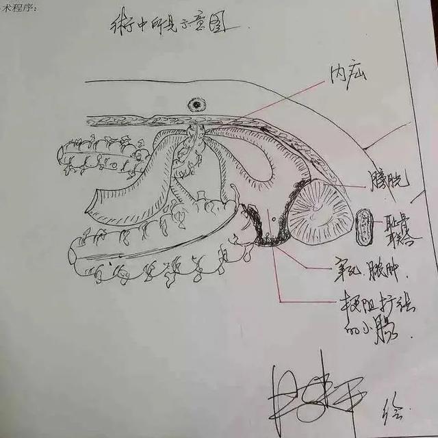 前海人寿广州总医院名誉院长汪建平教授手绘超赞「手术图谱」！