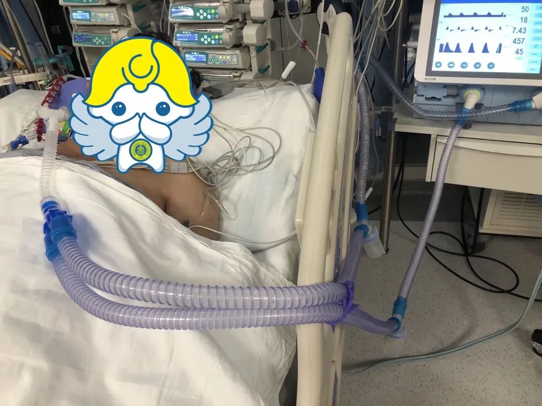 七旬大爷患鹦鹉热住进 ICU，1 个月全力抢救转危为安