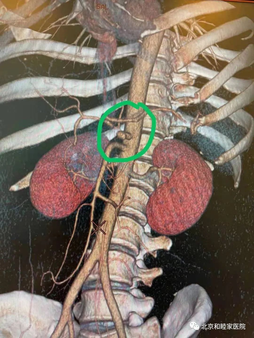 腹痛难忍,原来是罕见急腹症,急救马上开始……