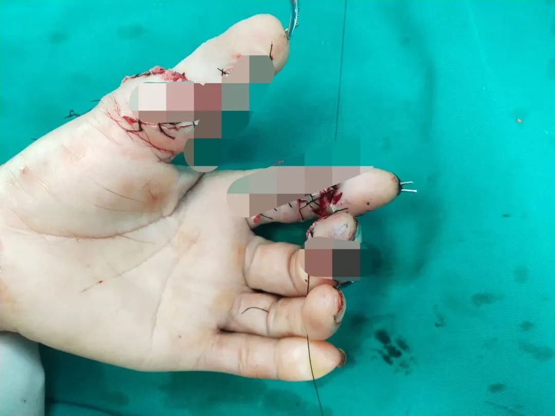 「移花接木」拇指再造，上海海华医院成功完成一例复杂拇指再造术