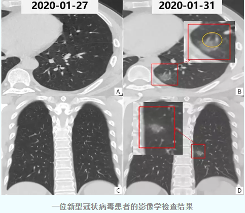 重磅！医学科研携手出版，提高新冠肺炎诊断效率