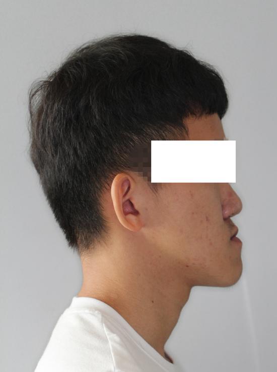 22 岁小伙牙齿「地包天」，北京大学深圳医院手术帮他矫正