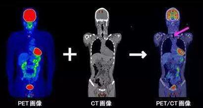 揭秘江北地区第一台 PET/CT