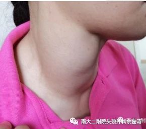 南昌大学第二附属医院头颈外科完成一例巨大甲状腺肿物切除术