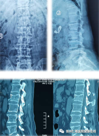 机器人「做手术」，治疗腰椎疏松压缩性骨折两天就能下地行走