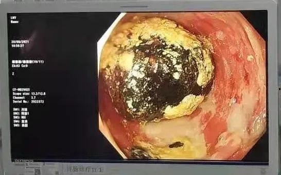 肠镜日记：当粪石遇到我