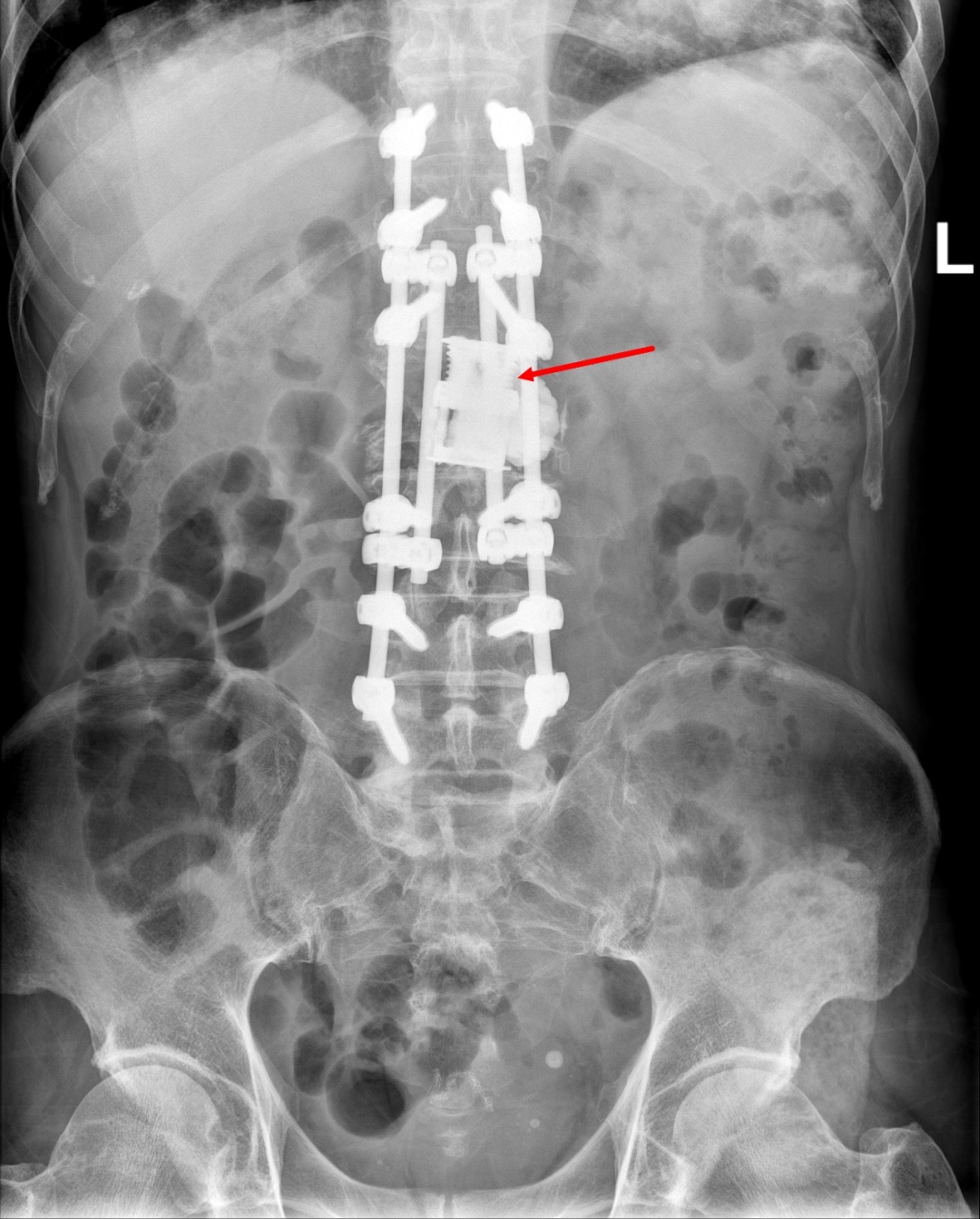 肿瘤转移到脊柱 = 没得治？杭州市萧山区中医院挺进骨科手术「雷区」，成功切除肿瘤