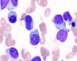 胡凯专栏丨追击多发性骨髓瘤终极难题：复发难治进展期浆细胞白血病