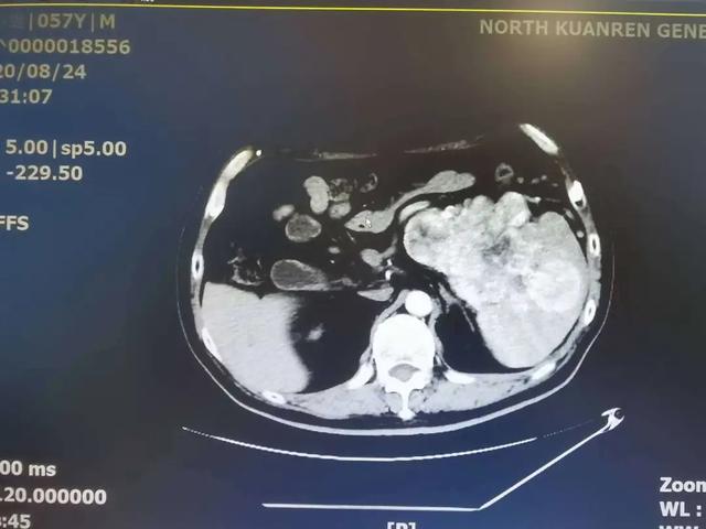 57 岁香港胰腺肿瘤患者手术成功：我的体内流着重庆人的血！