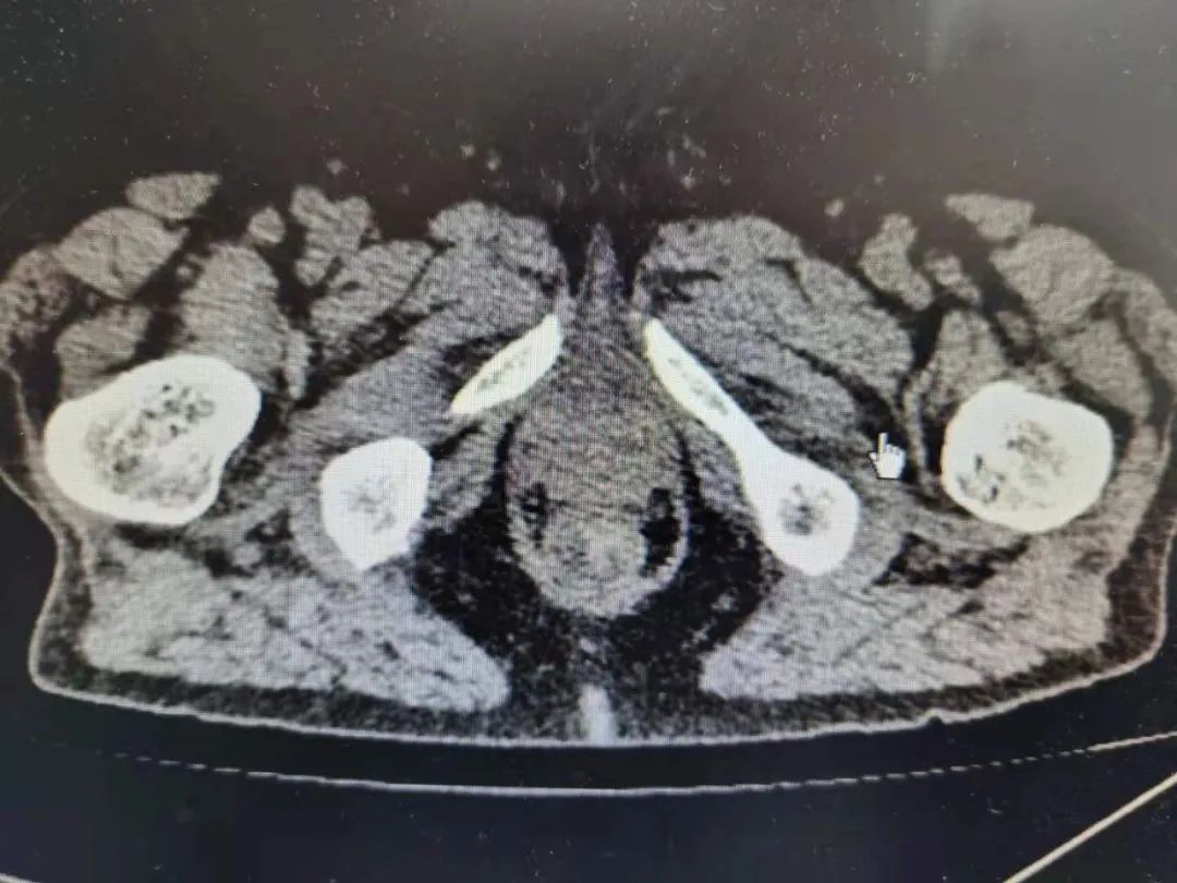 肿块距离「出口」仅 4 公分，医生突破手术极限让 91 岁老人「不改道」