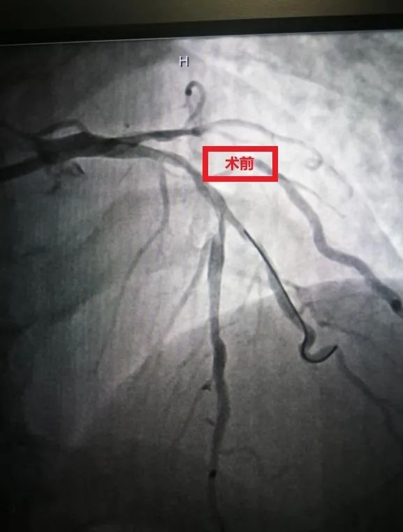 撑起生命通道：前海人寿广西医院心血管内科成功实施冠状动脉支架植入术