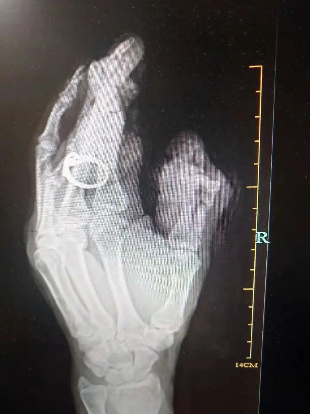 「移花接木」拇指再造，上海海华医院成功完成一例复杂拇指再造术