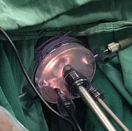 低位直肠癌患者踏上艰难保肛之路，广中医仙葫院区普外科 TaTME 手术为患者开希望之窗