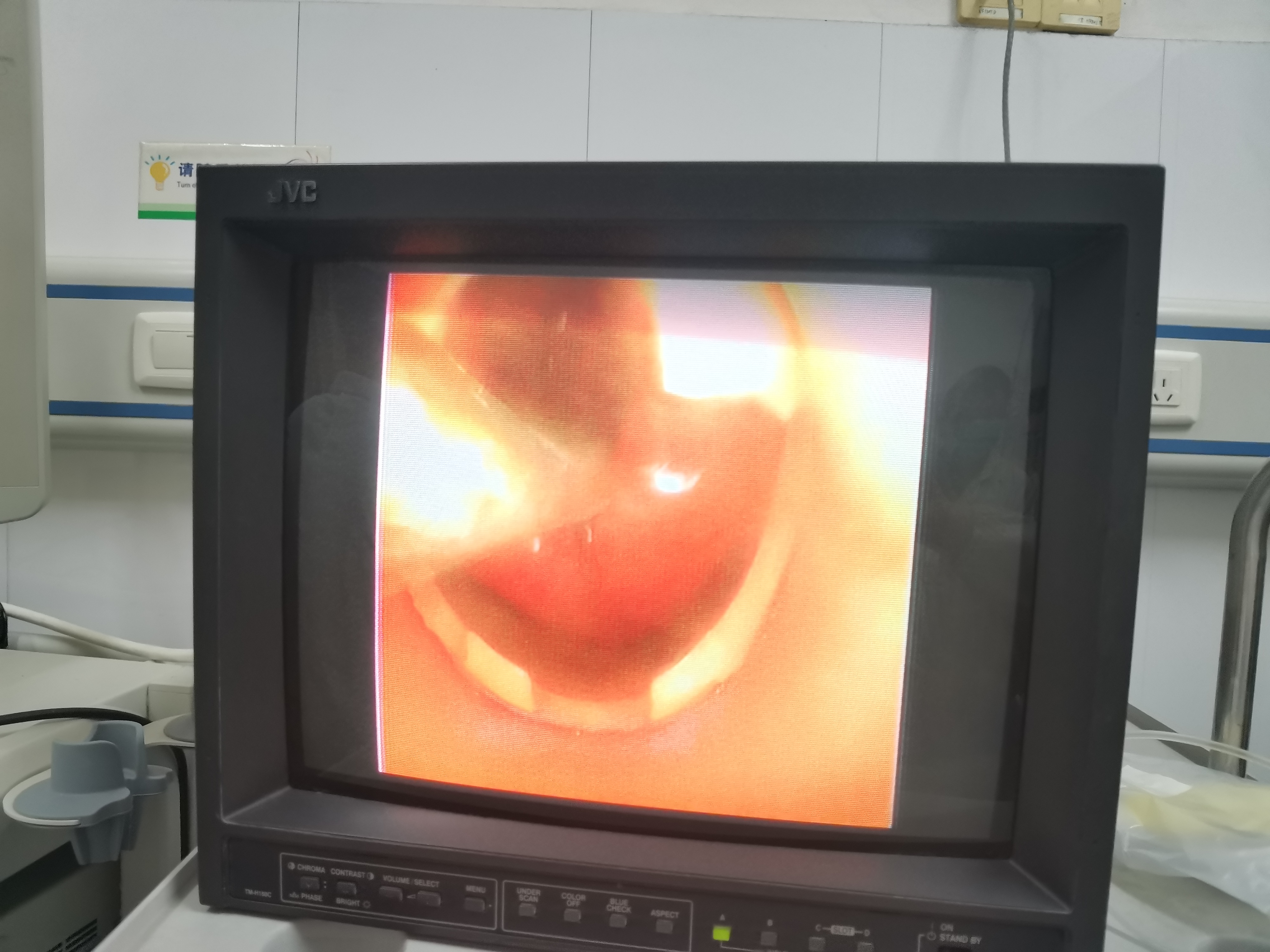 江西省儿童医院这项技术应用为气道狭窄患儿带来福音