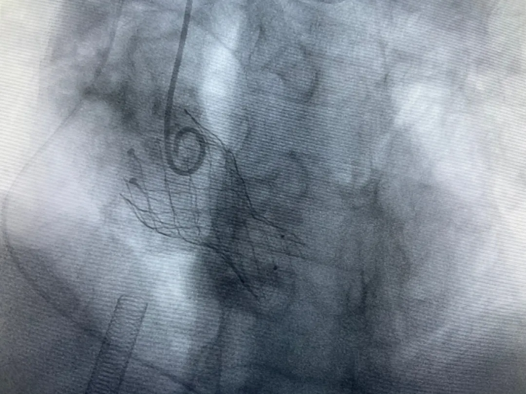 心脏外科团队用 TAVR 技术救治一名河南患者